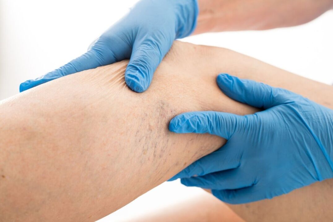Klinické ochorenie varikózy pre klinické