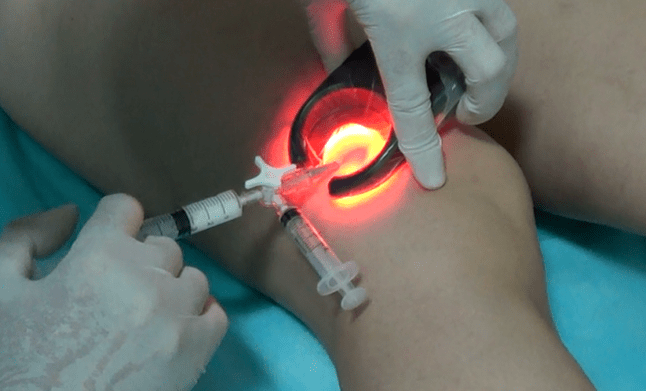 Skleroterapia je účinná metóda liečby kŕčových žíl na nohách